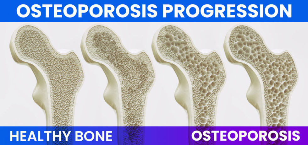 Bone Density Test (DEXA, DXA Scan) - Dr. James Webb - Tulsa, OK