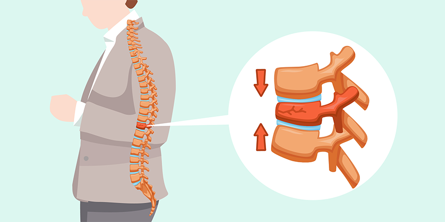 Spinal Compression Fractures: Causes, Symptoms, Treatment and