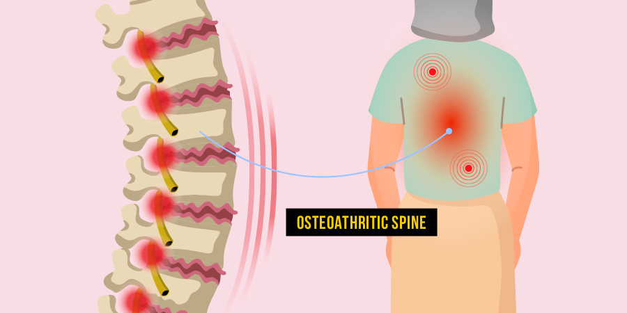 Osteoarthritic Spine