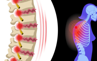 40 Fast Facts About Osteoarthritis of the Spine