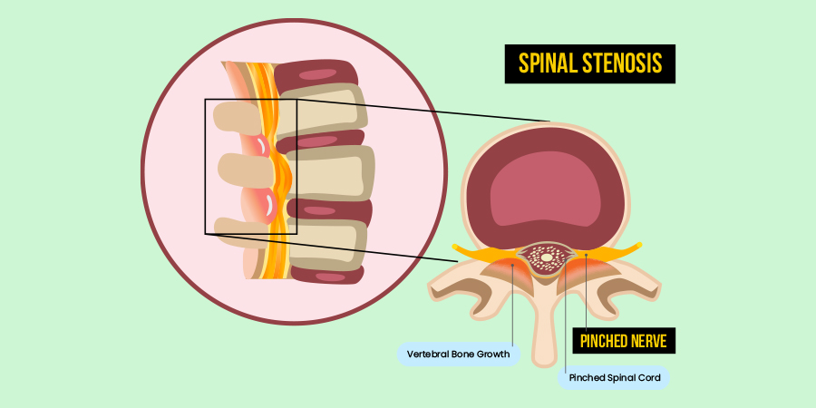 Spinal Stenosis